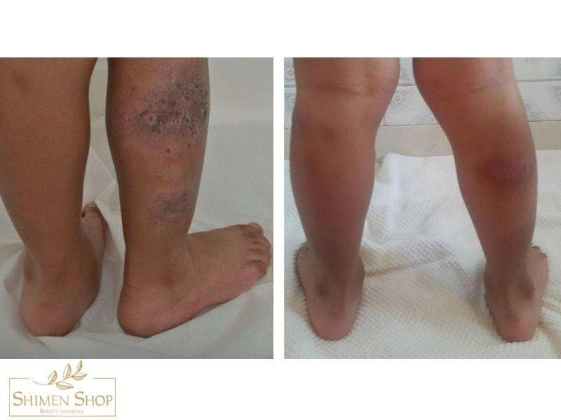 کرم ترمیم کننده پوست سیکالفیت اون